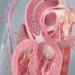 Doenças das válvulas cardíacas alcançam diagnóstico precoce e tratamentos menos invasivos