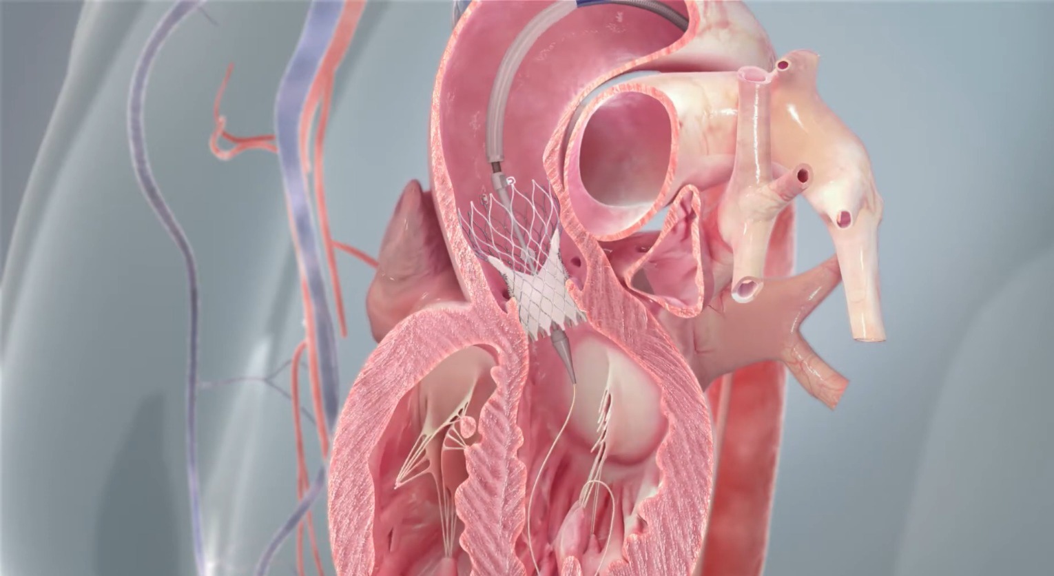 Procedimento TAVI ao inserir uma nova valvula artificial atraves de um cateter Divulgacao