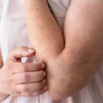 Janeiro Roxo chama a atenção a importância do diagnóstico precoce da hanseníase