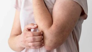 Hanseniase Imagem Divulgacao