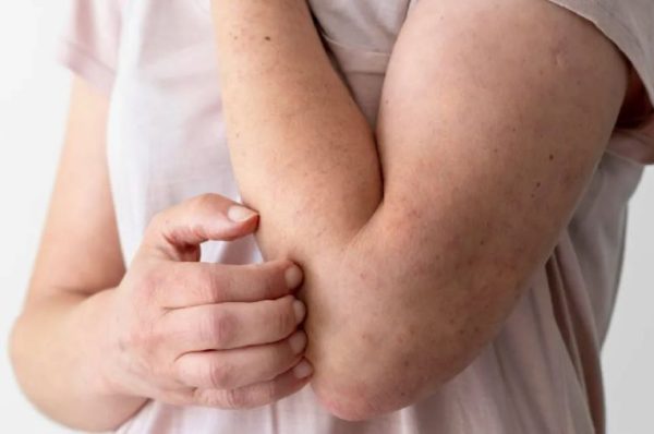 Janeiro Roxo chama a atenção a importância do diagnóstico precoce da hanseníase