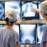 Diagnóstico precoce e cirurgia minimamente invasiva transformam o tratamento do câncer de pulmão